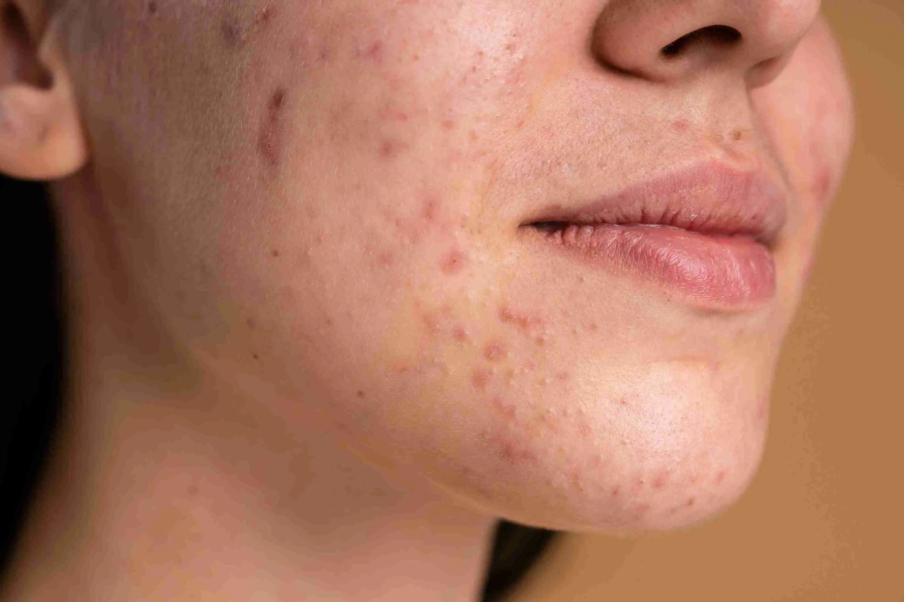 Best Skincare Routine for Acne-Prone Skin